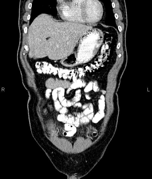 Cecal cancer with appendiceal mucocele (Radiopaedia 91080-108651 D 15).jpg