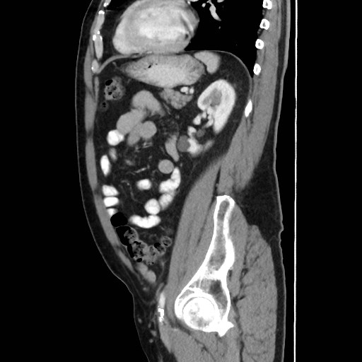 Cecal mass causing appendicitis (Radiopaedia 59207-66531 C 45).jpg