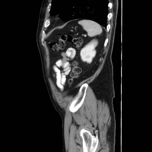 Cecal mass causing appendicitis (Radiopaedia 59207-66531 C 54).jpg