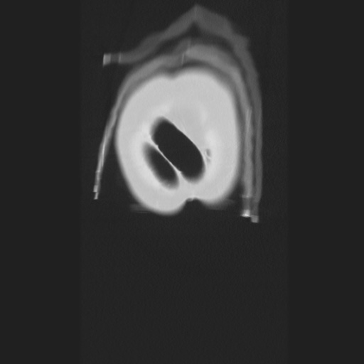 Cecal volvulus (Radiopaedia 75378-86620 Coronal lung window 11).jpg