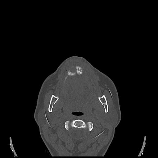File:Cemento-ossifying fibroma (Radiopaedia 21243-21149 Axial bone window 9).jpg