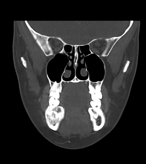 Cemento-ossifying fibroma (Radiopaedia 46243-50643 Coronal bone window 24).png