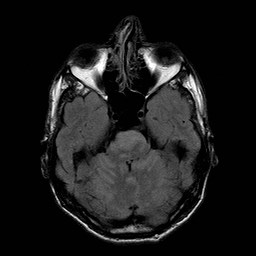 File:Central-variant posterior reversible encephalopathy syndrome (PRES) (Radiopaedia 43880-47358 Axial FLAIR 6).jpg