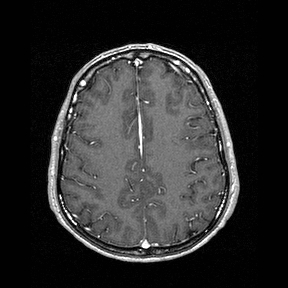 File:Central-variant posterior reversible encephalopathy syndrome (PRES) (Radiopaedia 43880-47358 Axial T1 C+ 119).jpg