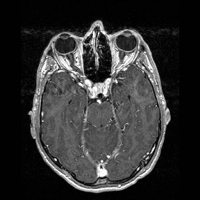 File:Central-variant posterior reversible encephalopathy syndrome (PRES) (Radiopaedia 43880-47358 Axial T1 C+ 53).jpg