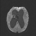 Central neurocytoma (Radiopaedia 56690-63469 Axial DWI 50).jpg