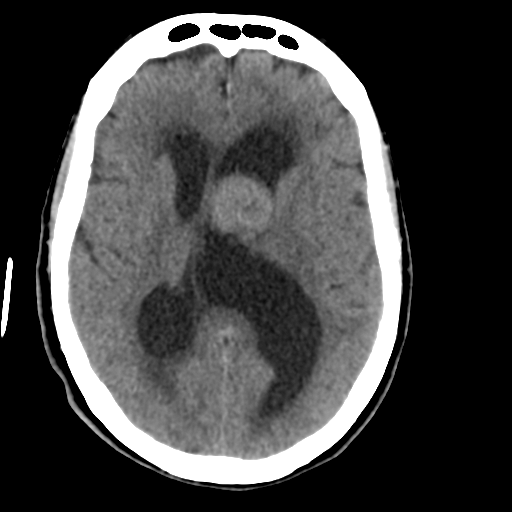 File:Central neurocytoma (Radiopaedia 65317-74346 Axial non-contrast 27).png