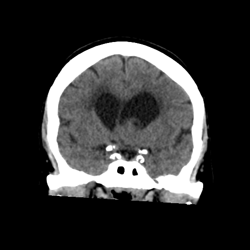 File:Central neurocytoma (Radiopaedia 65317-74346 Coronal non-contrast 24).png