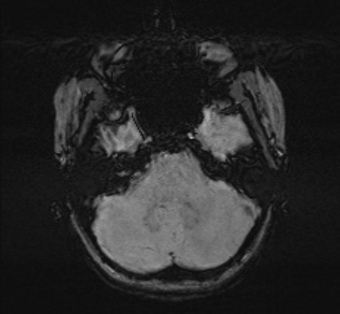 Central neurocytoma (Radiopaedia 70263-80336 Axial SWI 11).jpg