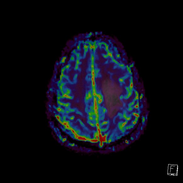 Central neurocytoma (Radiopaedia 84497-99872 Axial Perfusion 62).jpg