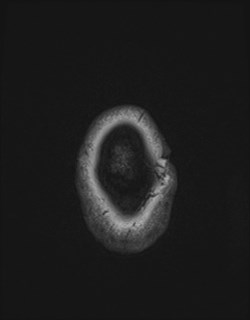 Central neurocytoma (Radiopaedia 84497-99872 Axial T1 180).jpg