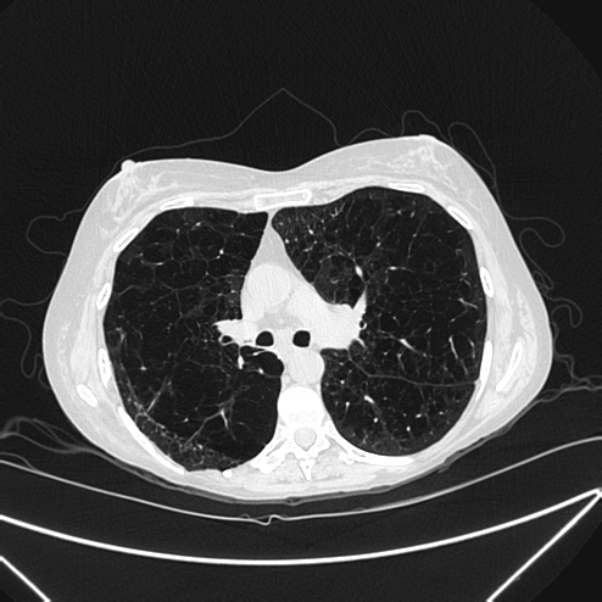 Centrilobular pulmonary emphysema (Radiopaedia 24495-24789 Axial lung window 41).jpg