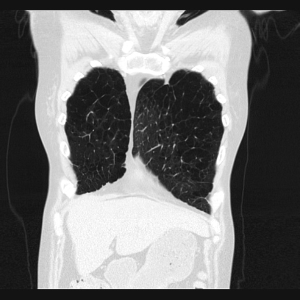 Centrilobular pulmonary emphysema (Radiopaedia 24495-24789 Coronal lung window 11).jpg