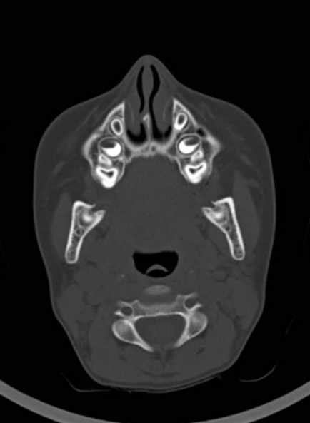 Cerebellar abscess (Radiopaedia 73727-84527 Axial bone window 9).jpg