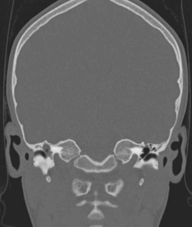 Cerebellar abscess (Radiopaedia 73727-84527 Coronal bone window 71).jpg