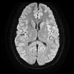 Cerebellar hemangioblastoma (Radiopaedia 29570-30077 Axial DWI 15).jpg