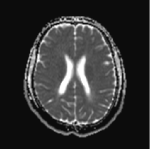 File:Cerebellar hemangioblastomas and pituitary adenoma (Radiopaedia 85490-101176 Axial ADC 22).png