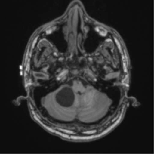 File:Cerebellar hemangioblastomas and pituitary adenoma (Radiopaedia 85490-101176 Axial T1 15).png