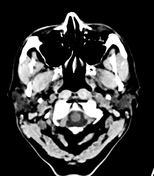 File:Cerebellar hemorrhage (Radiopaedia 37000-38669 Axial non-contrast 4).png