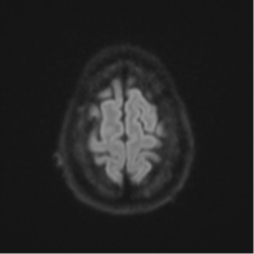 Cerebellar metastasis (Radiopaedia 51137-56765 Axial DWI 53).png