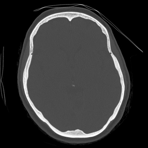 Cerebellar metastasis (cystic appearance) (Radiopaedia 41395-44258 Axial bone window 32).png