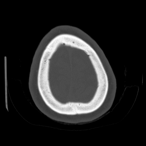 Cerebellar metastasis (cystic appearance) (Radiopaedia 41395-44258 Axial bone window 64).png