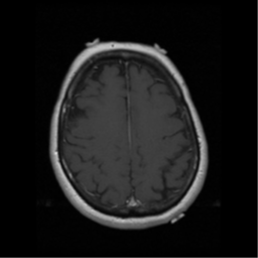 File:Cerebellar metastasis (cystic appearance) (Radiopaedia 41395-44262 Axial T1 C+ 16).png