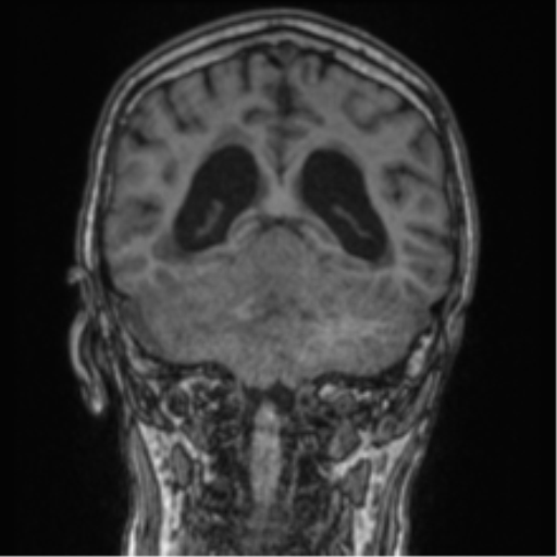 Cerebellar metastasis from lung adenocarcinoma (Radiopaedia 86690-102829 Coronal T1 39).png