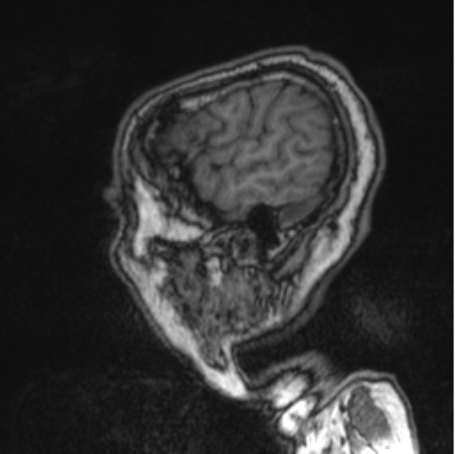 Cerebellar metastasis from lung adenocarcinoma (Radiopaedia 86690-102829 Sagittal T1 81).png