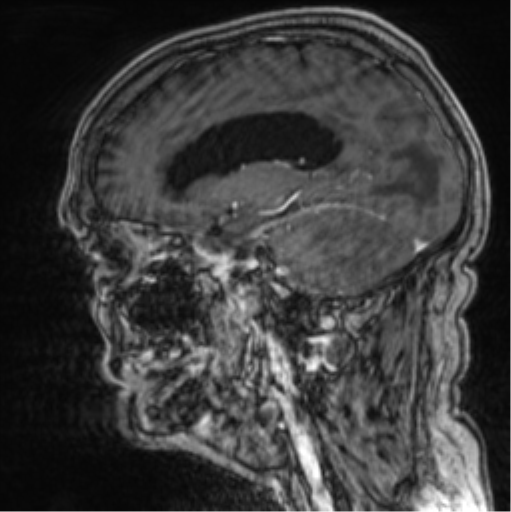 Cerebellar metastasis from lung adenocarcinoma (Radiopaedia 86690-102829 Sagittal T1 C+ 33).png