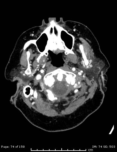 File:Cerebellar strokes due to intracranial giant cell arteritis (Radiopaedia 68799-78510 CT angiogram 74).jpg