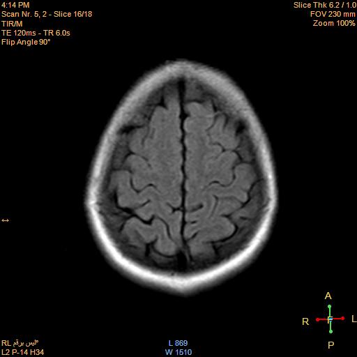 File:Cerebellopontine angle meningioma (Radiopaedia 22488-22525 Axial FLAIR 15).jpg