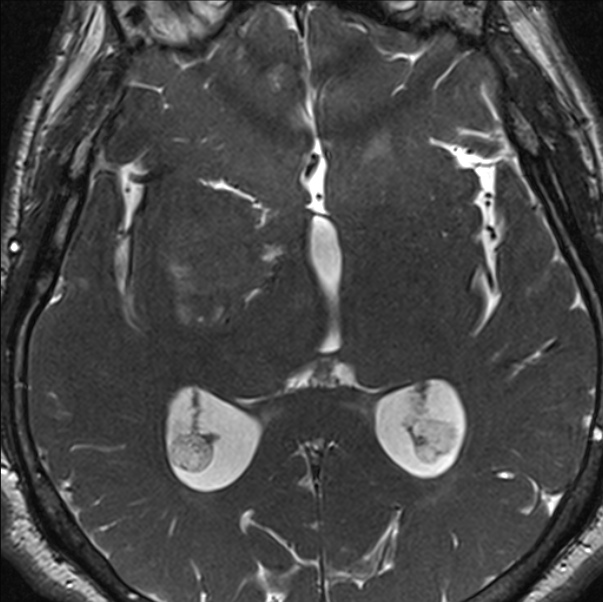 Cerebellopontine angle meningioma (Radiopaedia 24459-24764 I 52).jpg