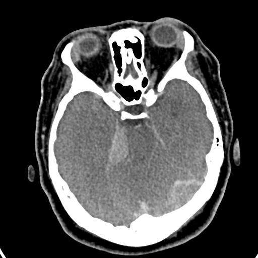 Cerebellopontine angle meningioma (Radiopaedia 35181-36714 A 10).jpg