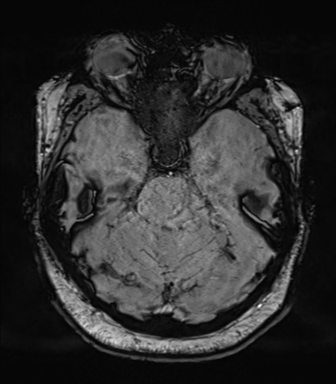 Cerebellopontine angle meningioma (Radiopaedia 48434-53348 Axial SWI 30).png