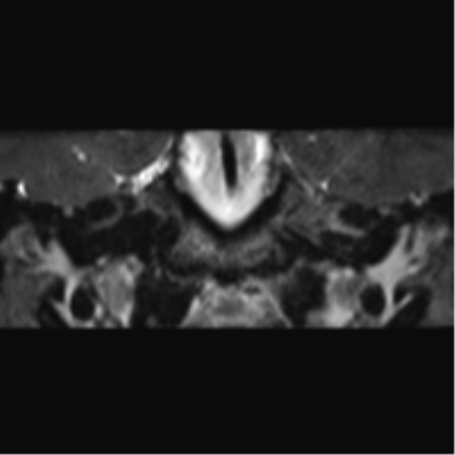 File:Cerebellopontine angle meningioma (Radiopaedia 48434-53348 Coronal T2 61).png