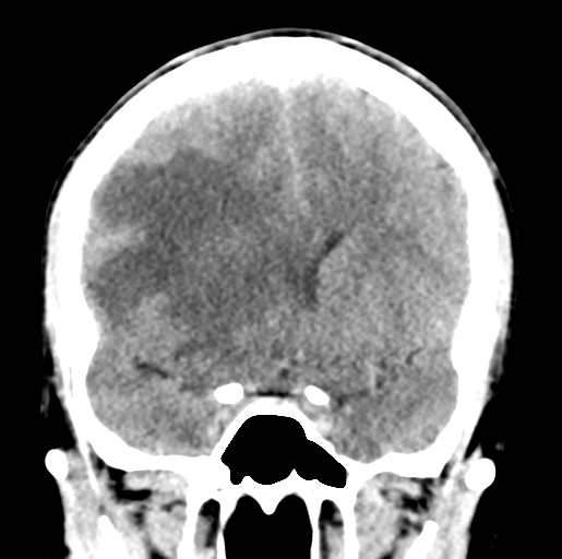 Cerebral abscess (Radiopaedia 60342-68008 Coronal non-contrast 25).png