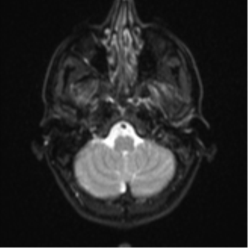 Cerebral abscess (Radiopaedia 60342-68009 Axial DWI 5).png
