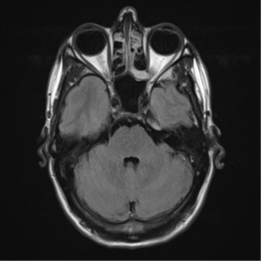 File:Cerebral abscess (Radiopaedia 60342-68009 Axial FLAIR 8).png