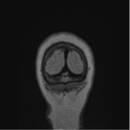 Cerebral abscess from pulmonary arteriovenous malformation (Radiopaedia 86275-102291 Coronal FLAIR 10).png