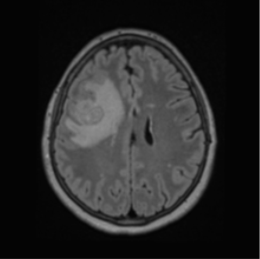 Cerebral abscess from pulmonary arteriovenous malformation (Radiopaedia 86275-102291 J 50).png