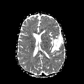 File:Cerebral abscess post cardiac surgery (Radiopaedia 27244-27420 Axial ADC 15).jpg