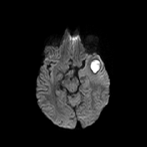 File:Cerebral abscess post cardiac surgery (Radiopaedia 27244-27420 Axial DWI 7).jpg