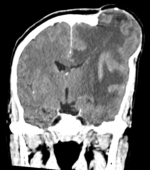 File:Cerebral abscesses (Radiopaedia 70458-80568 Coronal Contrast 33).jpg