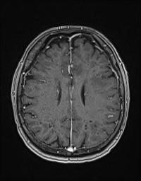 Cerebral amyloid angiopathy-related inflammation (Radiopaedia 58270-65377 Axial T1 C+ fat sat 98).jpg