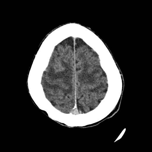 Cerebral amyloid angiopathy-related inflammation (Radiopaedia 74836-85848 Axial non-contrast 51).jpg