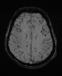 Cerebral amyloid angiopathy-related inflammation (Radiopaedia 74836-85849 Axial SWI 49).jpg