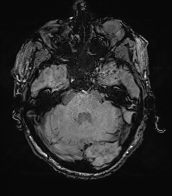 File:Cerebral amyloid angiopathy (Radiopaedia 46082-50433 Axial SWI 21).png