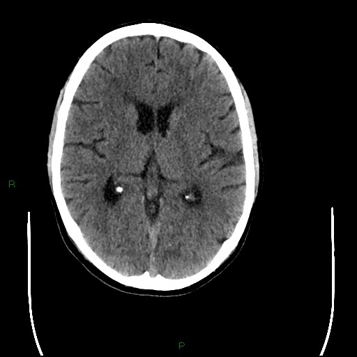 Cerebral amyloid angiopathy (Radiopaedia 77506-89665 Axial non-contrast 56).jpg