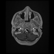 Cerebral and spinal tuberculosis (Radiopaedia 90489-107837 Axial T1 C+ 40).jpg